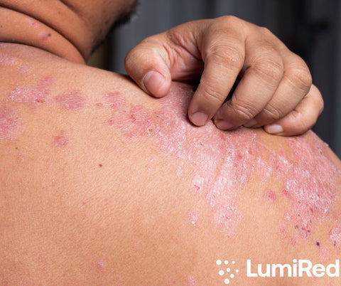 From Flare-Ups to Freedom: Discover the Empowering Benefits of Red Light Therapy for Psoriasis