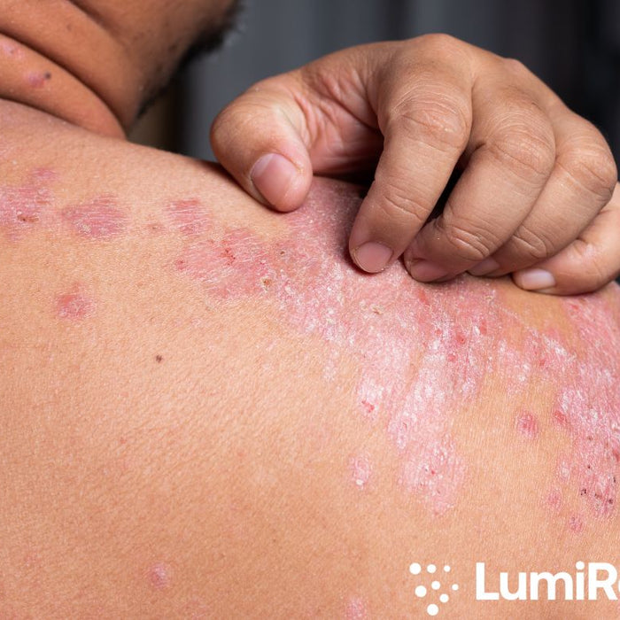 From Flare-Ups to Freedom: Discover the Empowering Benefits of Red Light Therapy for Psoriasis