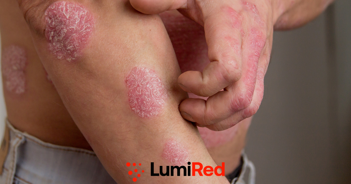 Can Red Light Therapy Treat Psoriasis? Everything You Need to Know
